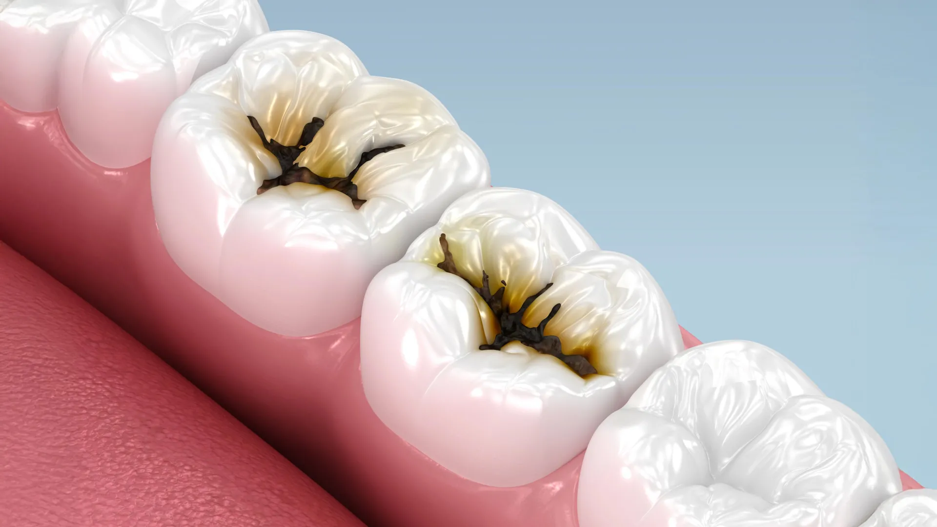 A simple liquid can stop cavities without drilling, major study confirms